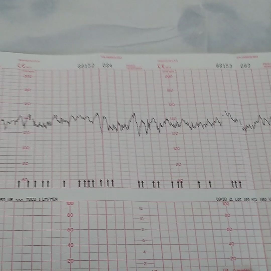 cardiotocografia fetal